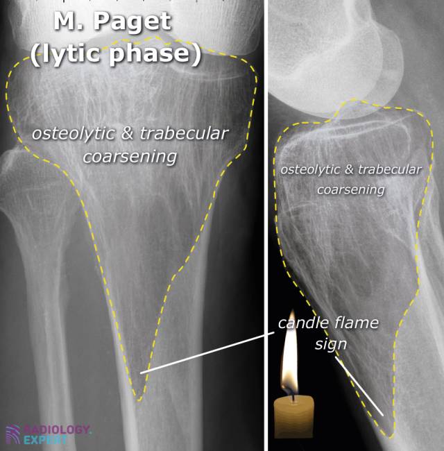 Bone tumours